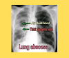 What is lung abscess?