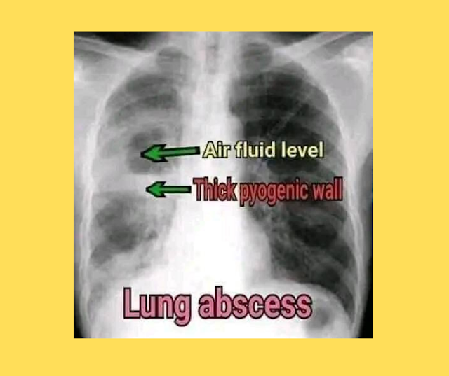 What is lung abscess?