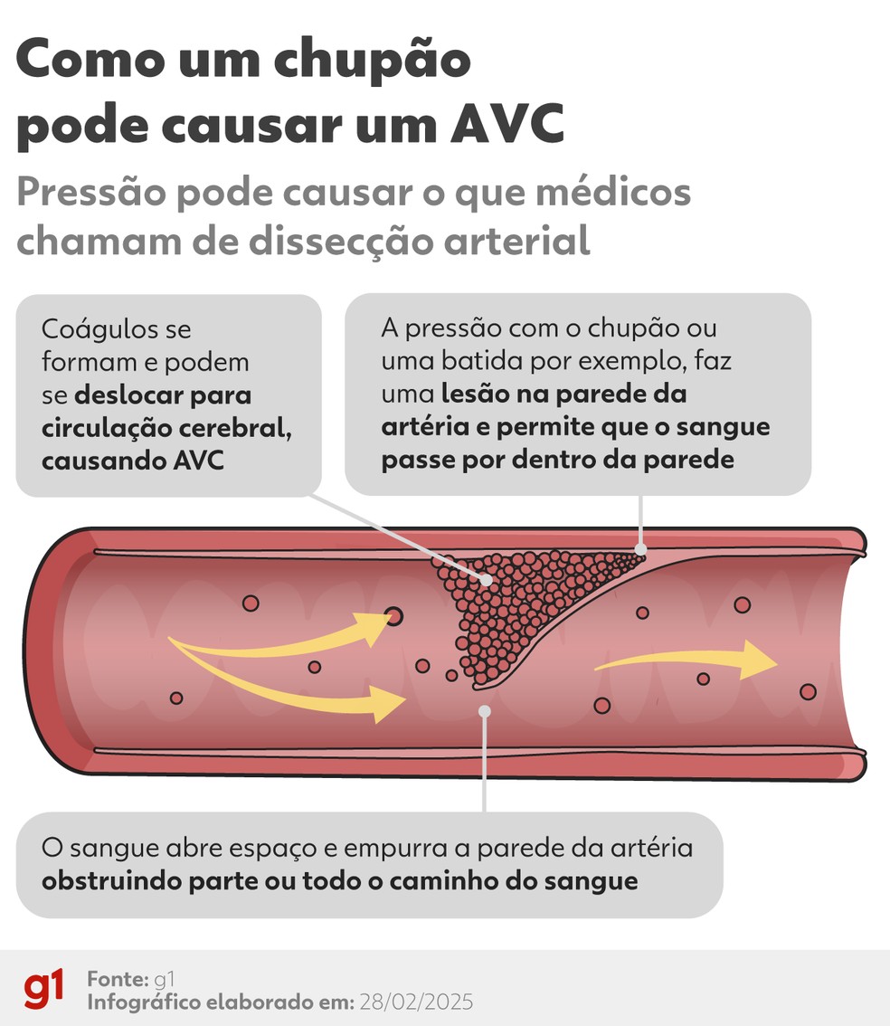 Arte explica como chupo acabou levando a um AVC  Foto: Arte/g1