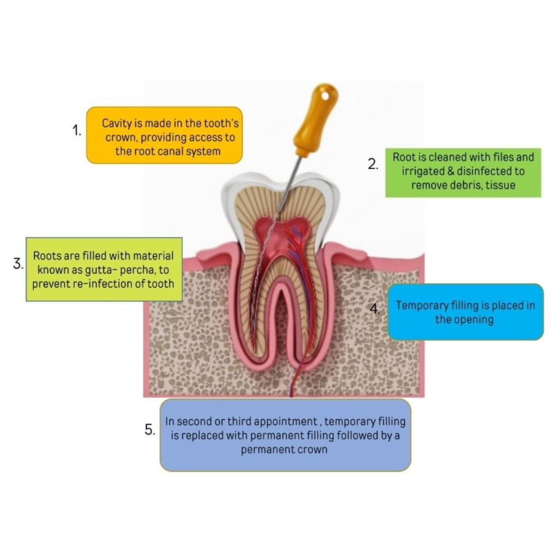 Root Canal Procedure: 5 Essential Steps to Save Your Tooth