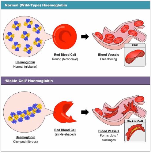 Sickle Cell Anemia