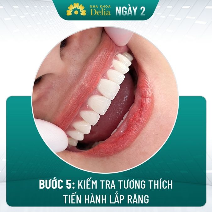 Quy trình bọc răng sứ cho răng cửa chuẩn quốc tế tại nha khoa thẩm mỹ quốc tế Delia