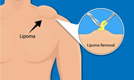 lipoma removal, Picture