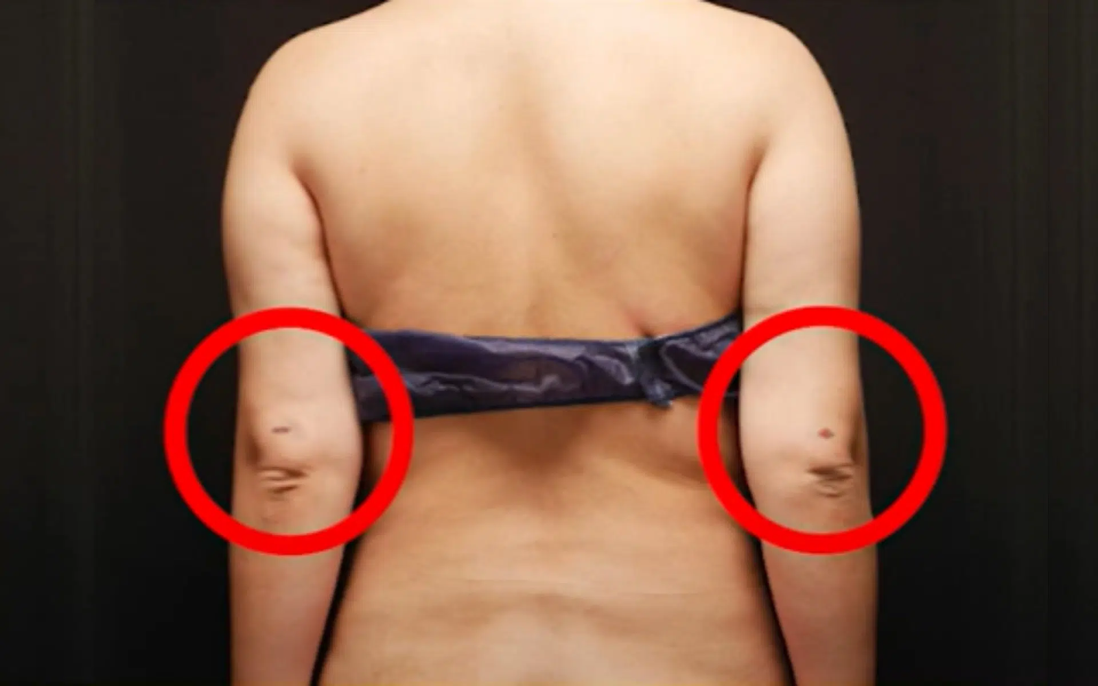 liposuction scars arms