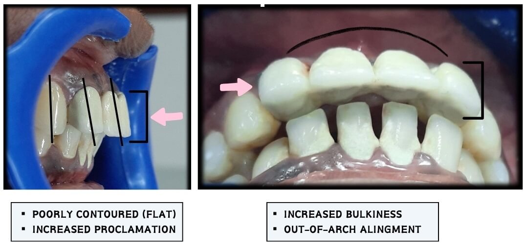 arch alignments