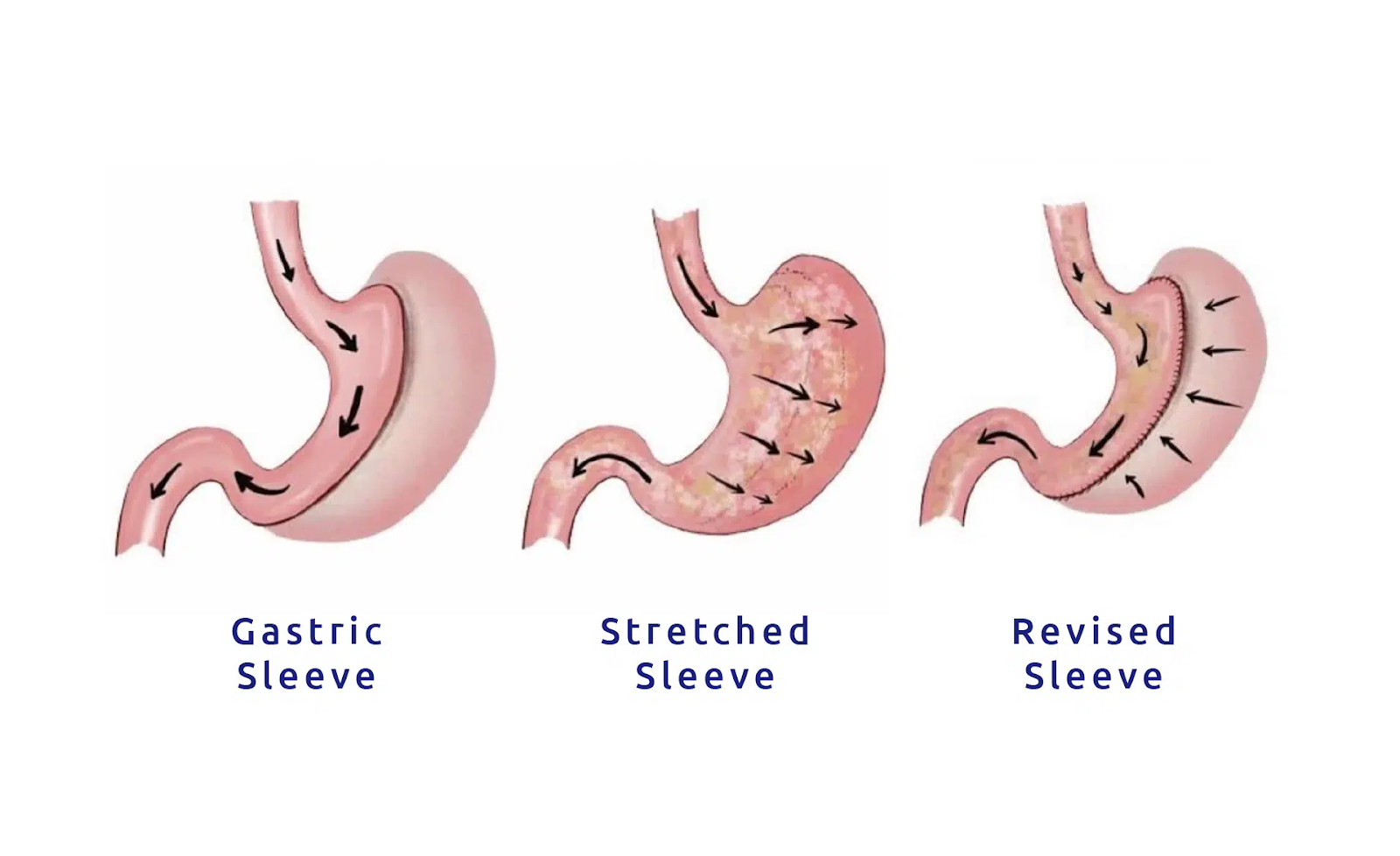 Gastric sleeve Stretching guidelines