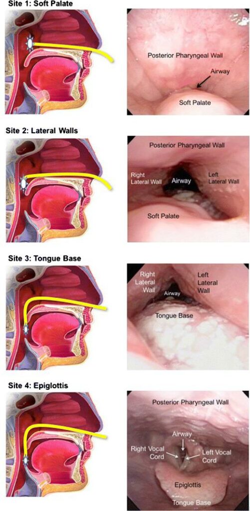 dise levels obstructions