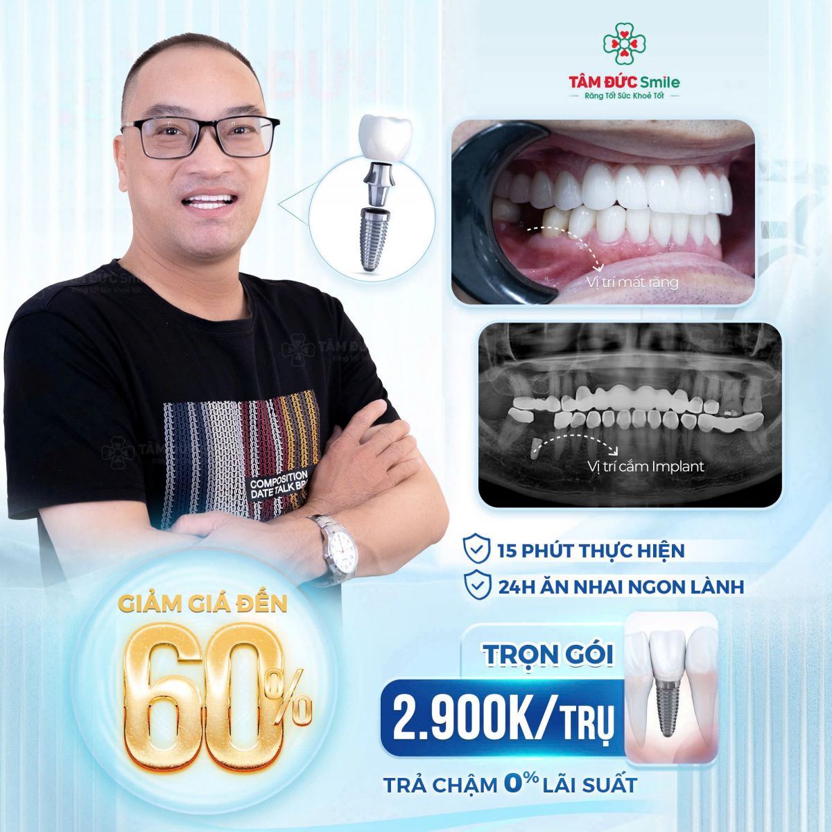 ưu đãi trồng răng implant tại nha khoa tâm đức smile