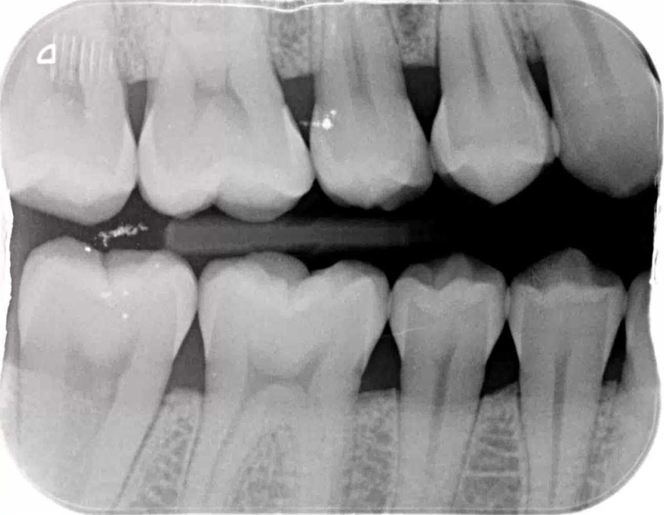 Bite wing X-ray