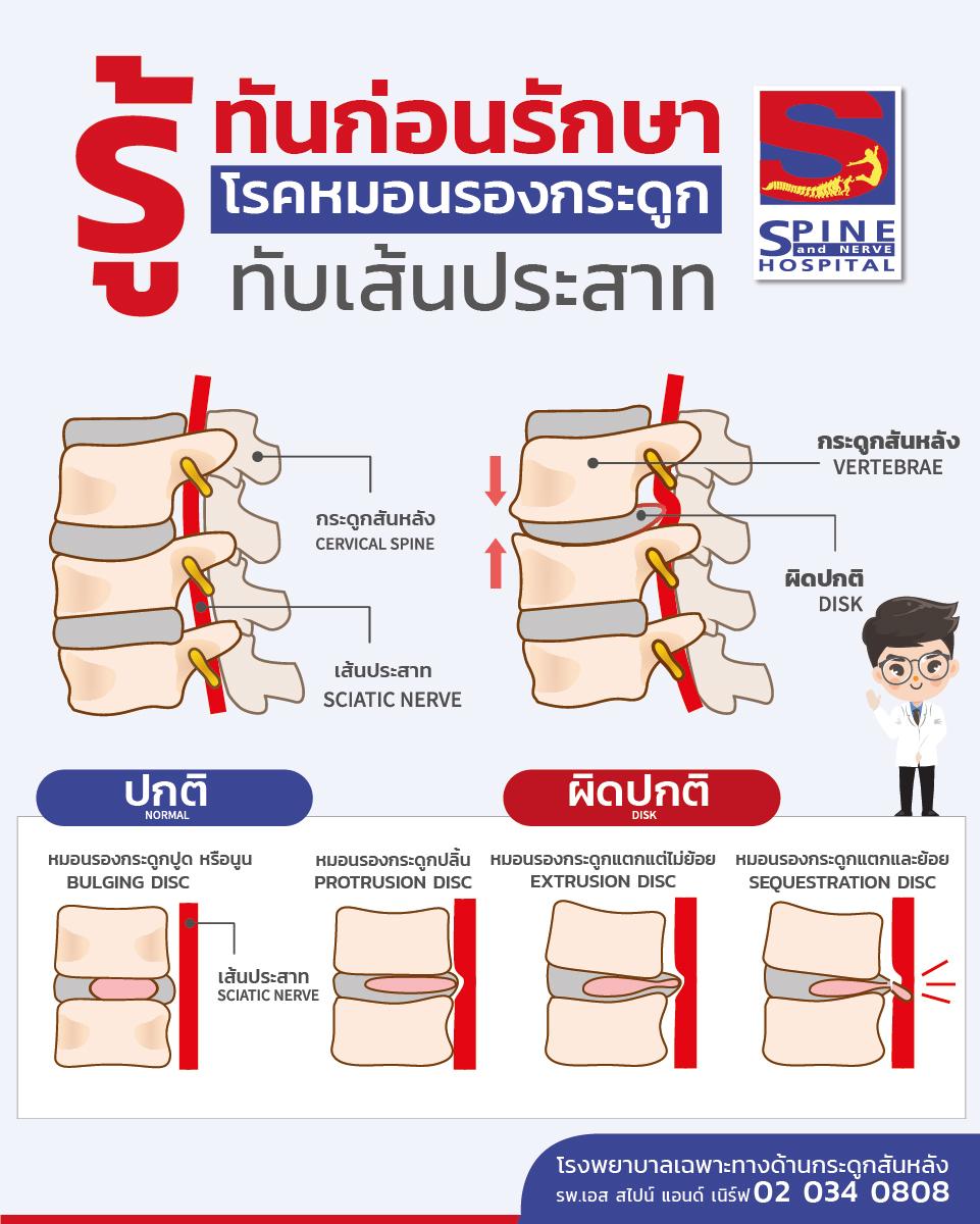 รู้ทันก่อนรักษา โรคหมอนรองกระดูกทับเส้นประสาท-01