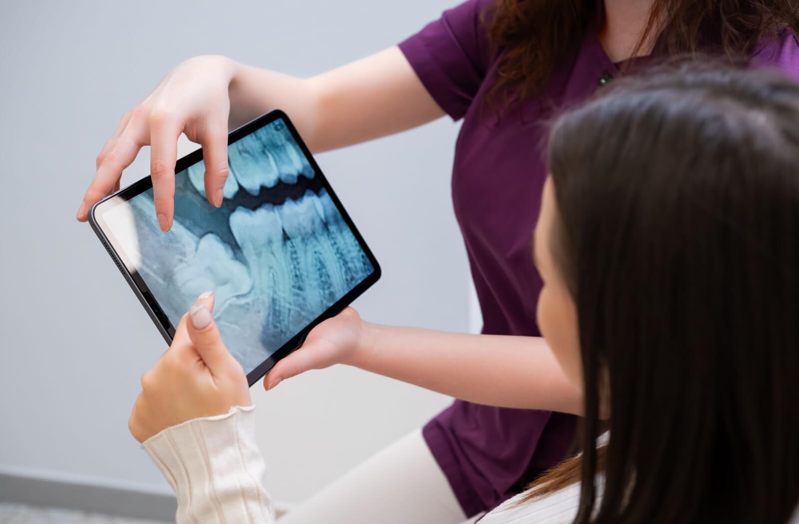 dentist showing an x-ray of impacted wisdom teeth to a patient to explain tooth extraction
