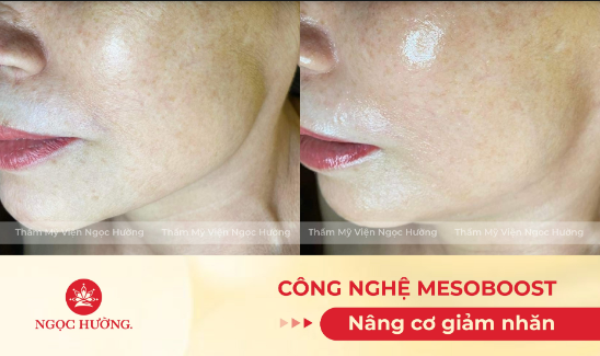 Dịch vụ nâng cơ giảm nhăn an toàn, hiệu quả