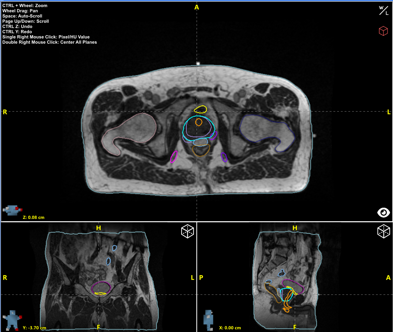 MR Male Pelvis Radformation AutoContour