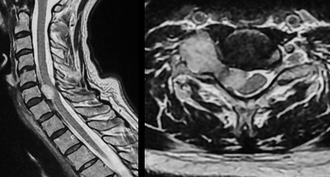 Radiology Schwannoma - spine