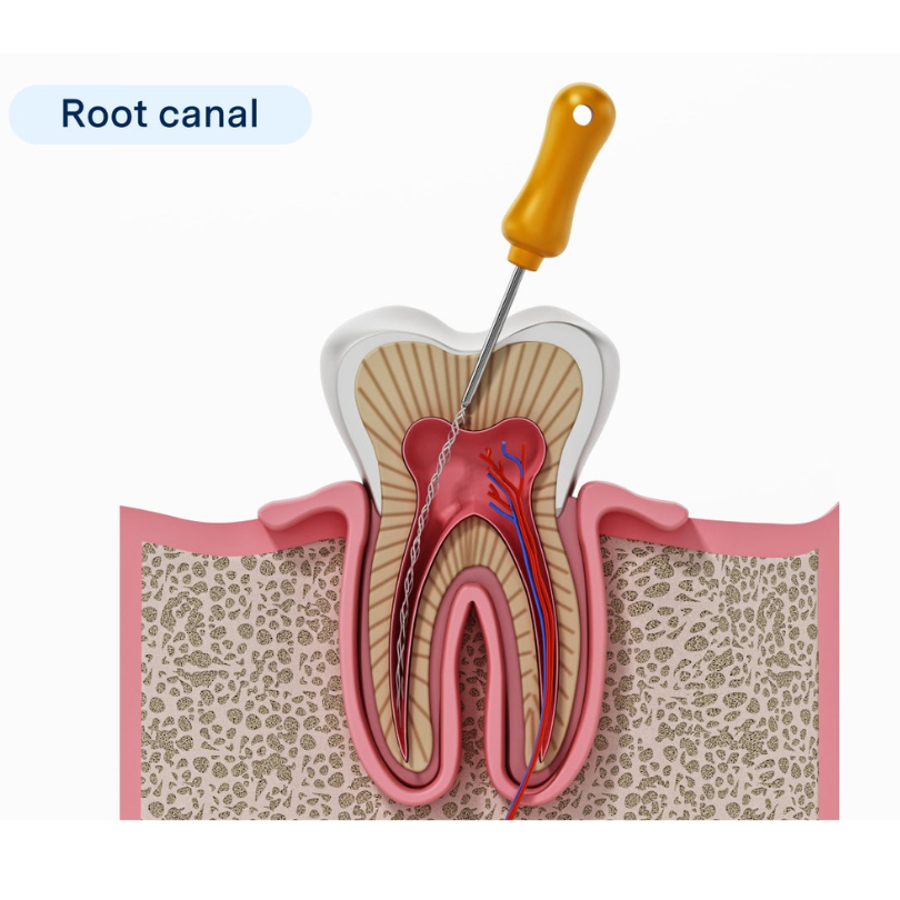 root canal life expectancy
