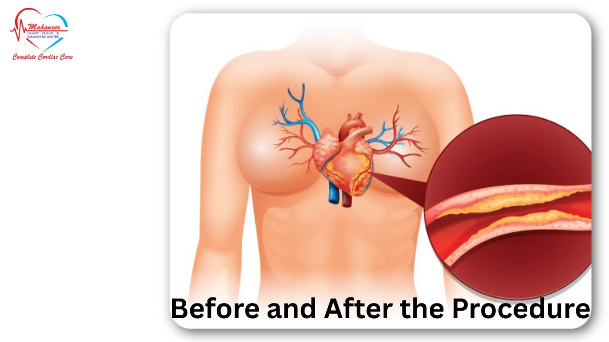 Pericardiocentesis by Dr Rakesh Jain - Best cardiologist