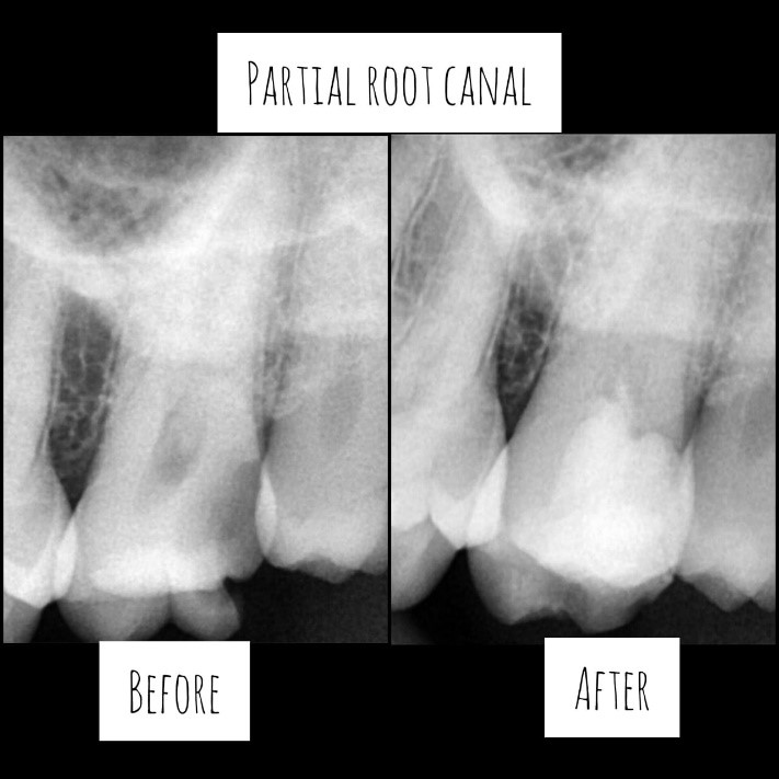 Partial Root Canal 