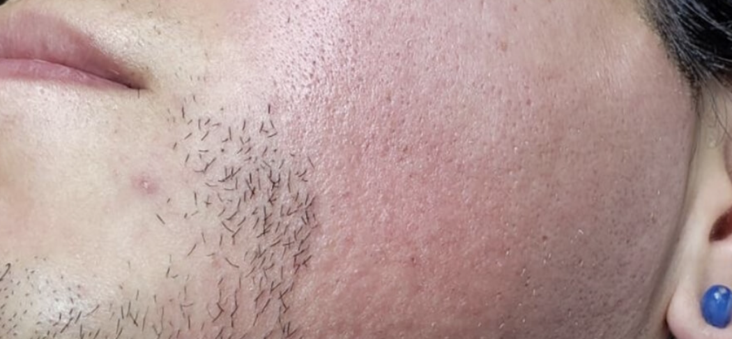 An image of someone with Redness and Irritation from electrolysis hair removal