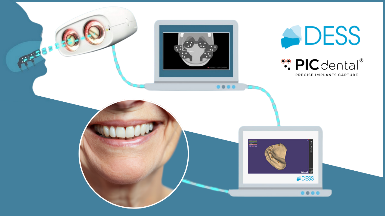 Maximum Precision | The Benefits of Photogrammetry in Full Arch Implant Restorations