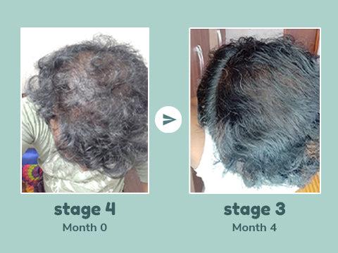 Stage 4 male pattern hair loss