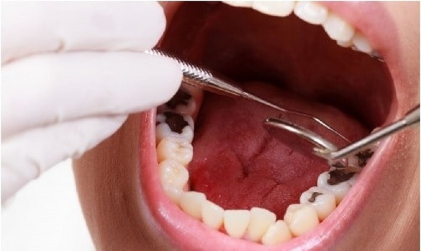 Trám răng sâu có lấy tủy không? Giải đáp từ chuyên gia Nha khoa Sing