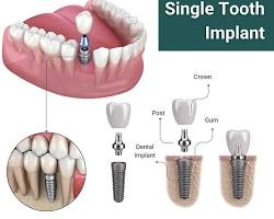 Image of Dental Implant