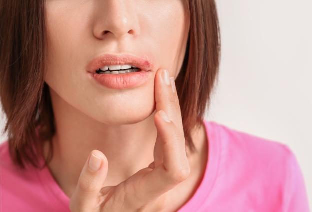 Women cold sores