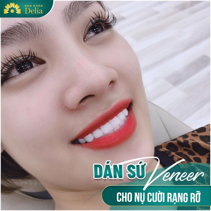 Mức giá dán sứ siêu mỏng không hề rẻ