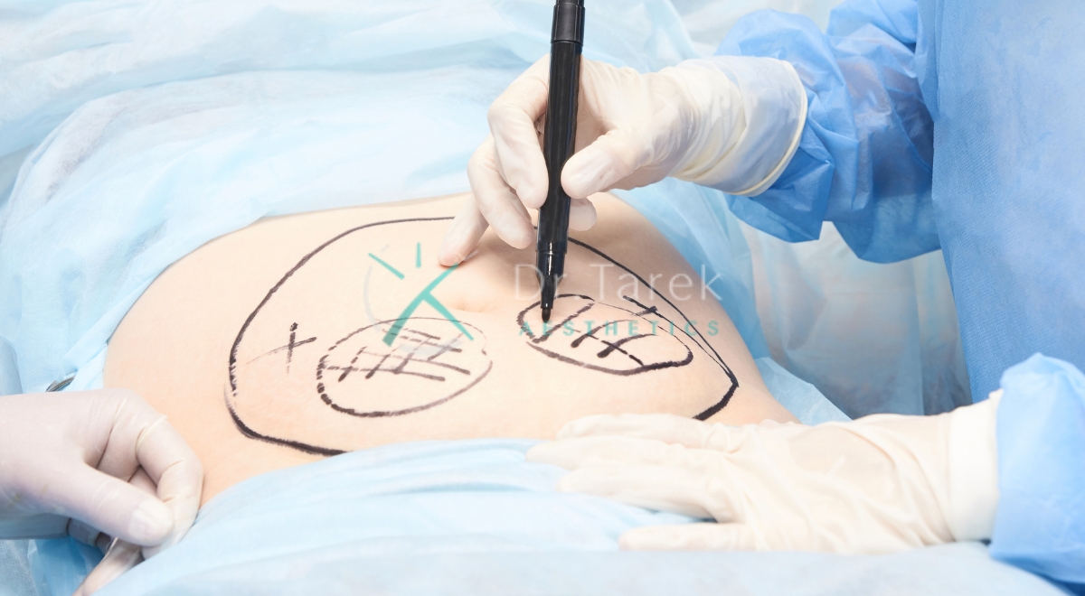 Where Are Liposuction Scars 4 Dr. Tarek Aesthetics | Best Plastic Surgeon In Dubai Where Are Liposuction Scars