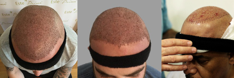 Wear headbands after hair transplants