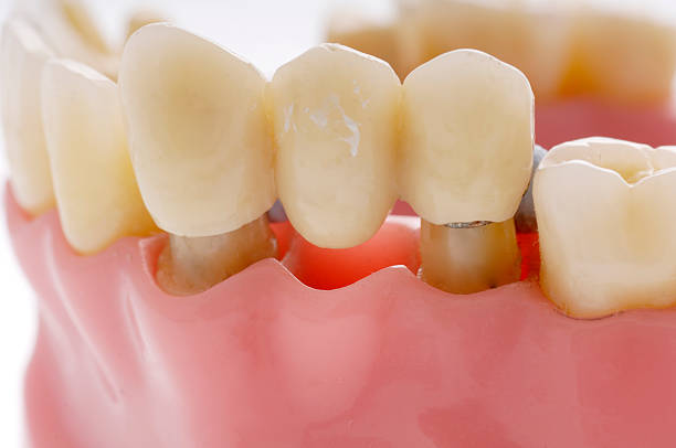 What is a Dental Bridge in Concord Mills, Concord, near Charlotte, Huntersville, and Kannapolis, NC?