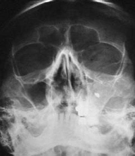 http://campus.cerimes.fr/chirurgie-maxillo-faciale-et-stomatologie/enseignement/stomatologie9/site/html/images/figure8.jpg