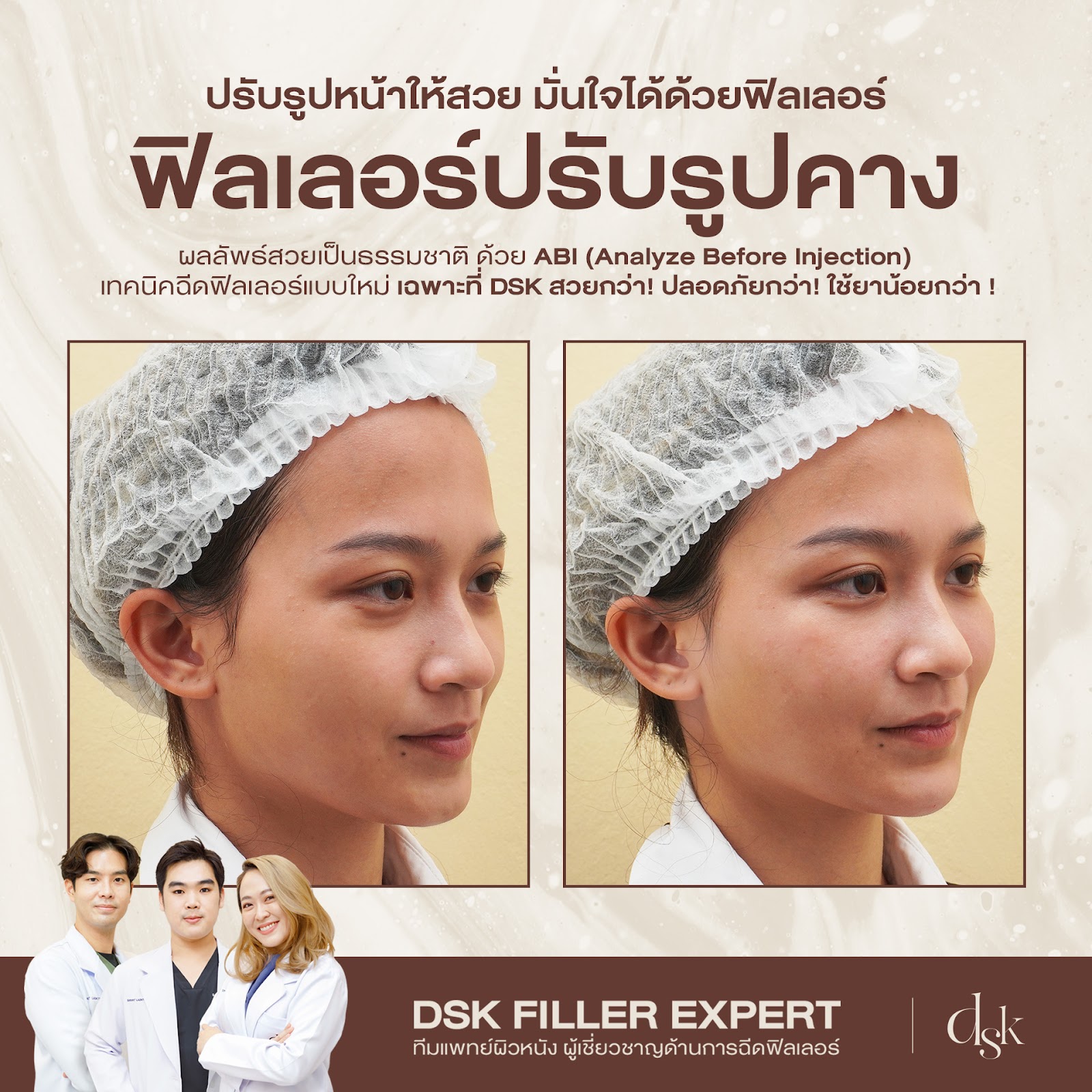 รีวิวฟิลเลอร์คางที่ DSK Clinic