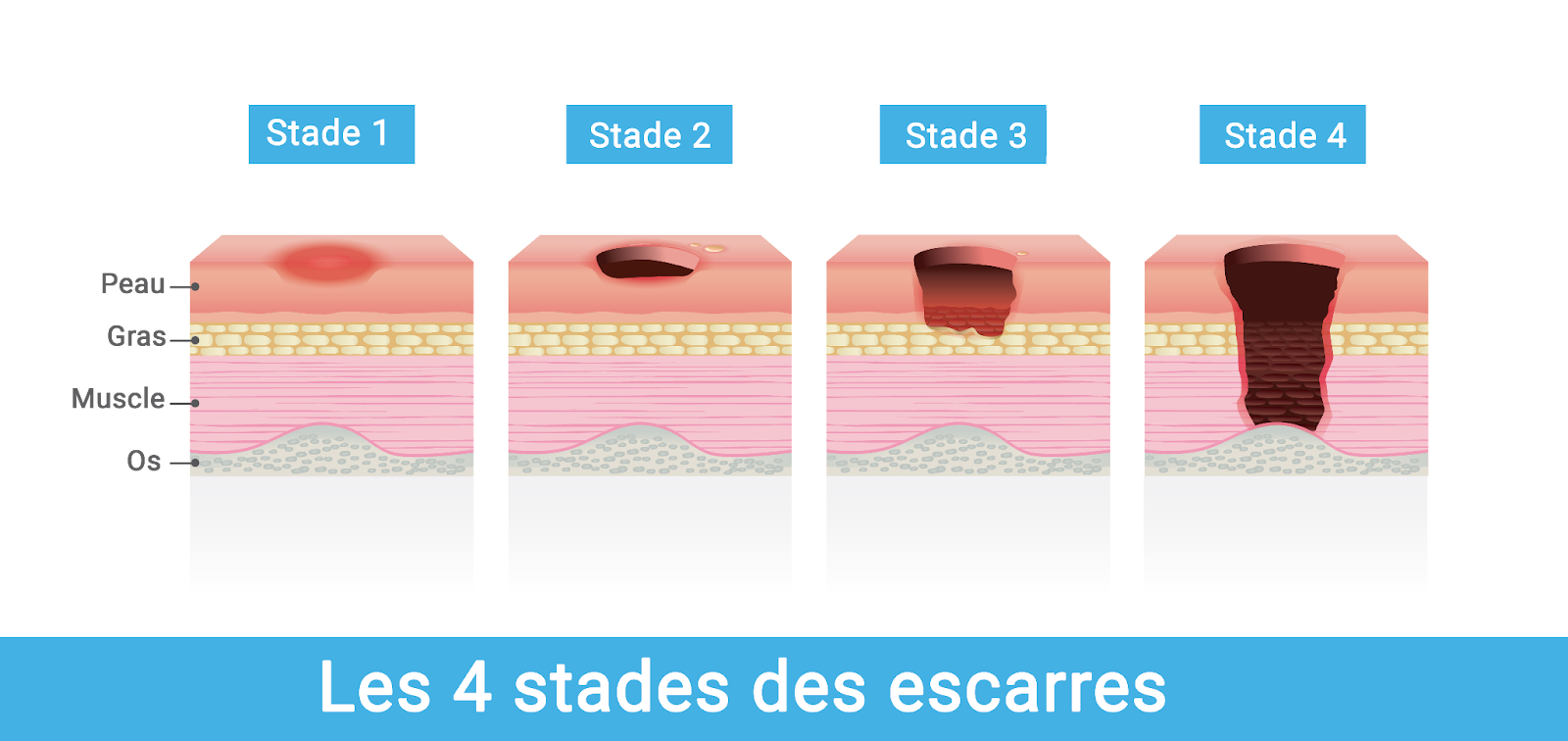 Les différents stades des escarres illustrés - Retraite Plus