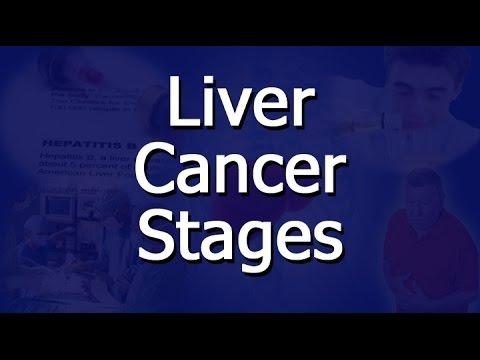 Image result for Stages of Liver Cancer