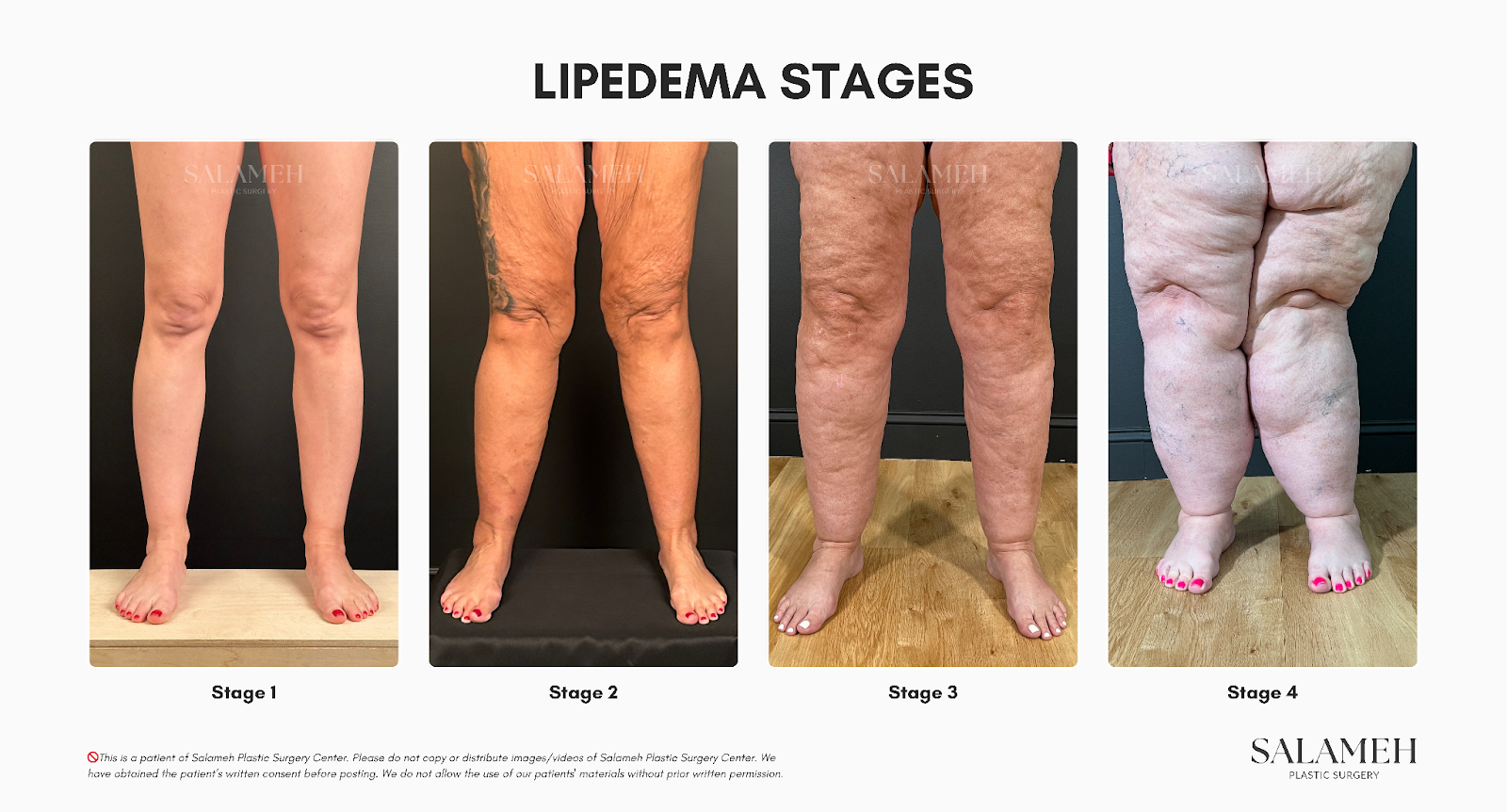 Photo showing the different four (4) stages of lipedema. It shows actual photos from stage 1 lipedema up to stage 4 lipedema.