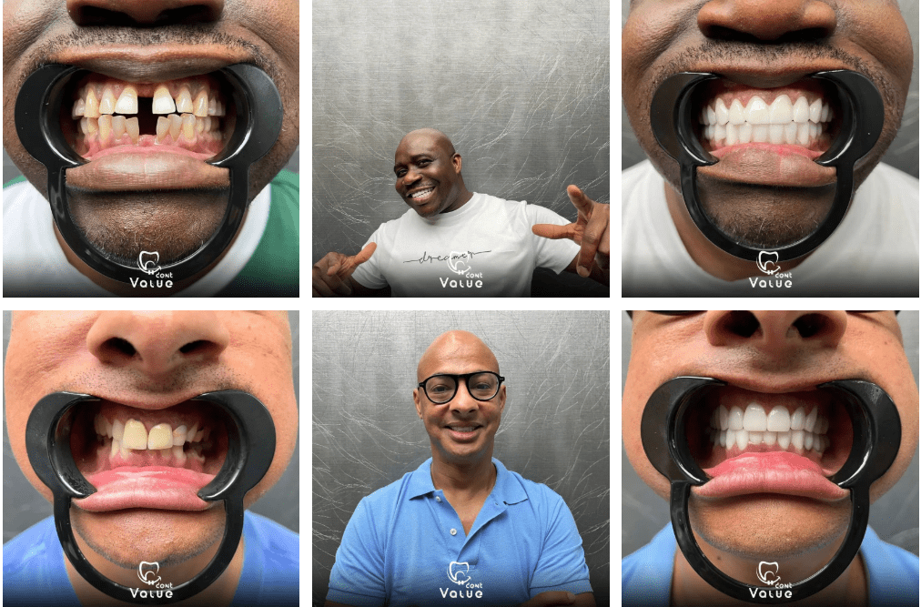 Hollywood Smile in Istanbul Turkey