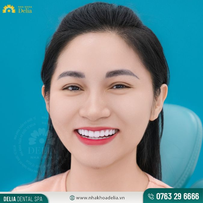 Diamond Plus kết hợp giữa sứ Zirconia và bột kim cương tạo nên màu sắc trắng sáng