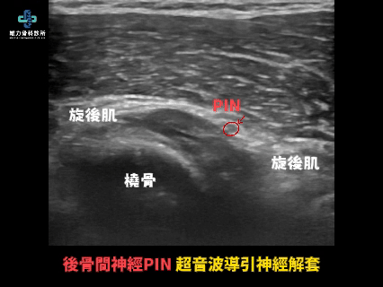 超音波導引神經解套