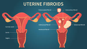 What to Expect During Your First Period After Myomectomy