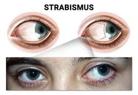 Strabismus