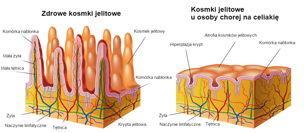 Celiakia - co to za choroba? - informacje dla pacjenta