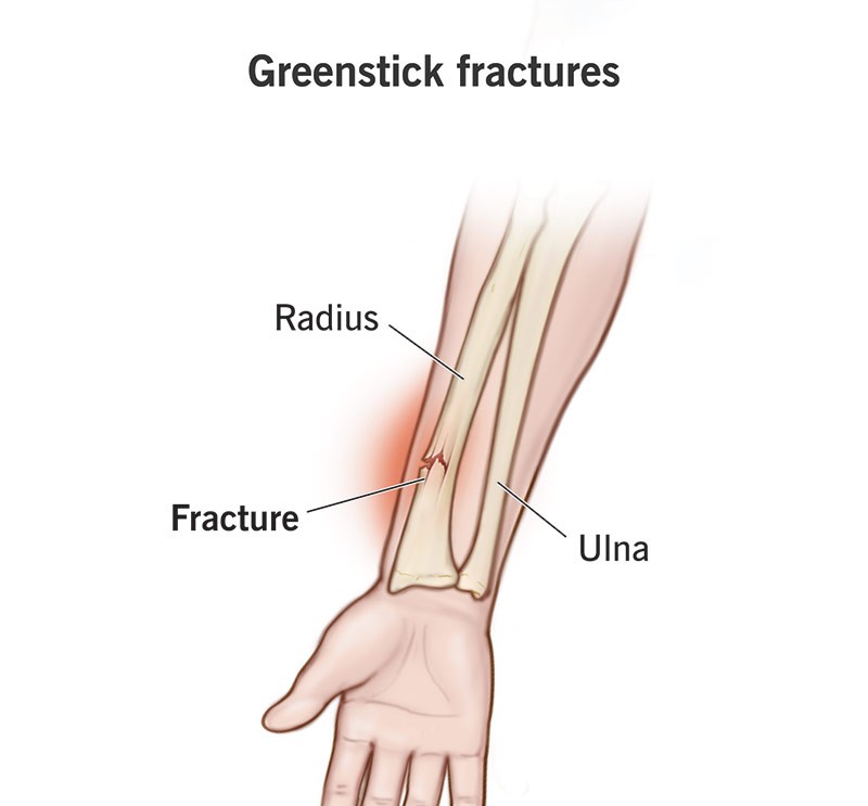 GreenStick Fracture
