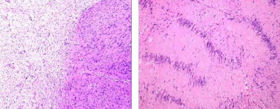 Schwannoma