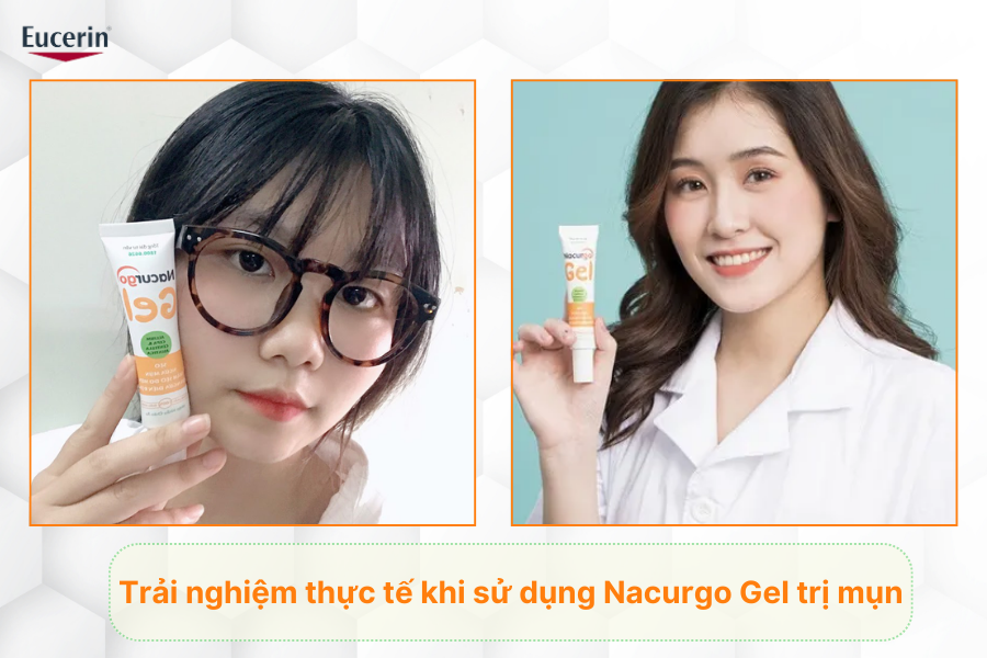 Trải nghiệm thực tế khi sử dụng Nacurgo Gel trị mụn