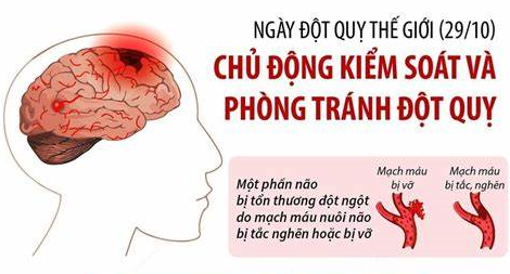  Đột quỵ là bệnh nguy hiểm, chủ động phòng ngừa từ sớm là điều nên làm