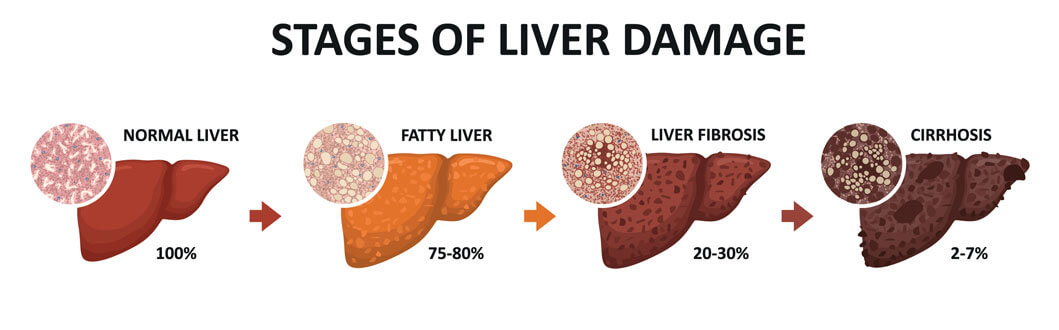 A diagram showing the different stages of liver disease and damage.