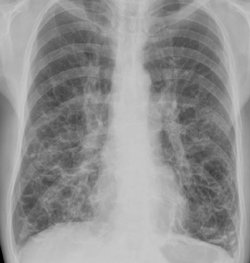 Bronchiectasis 