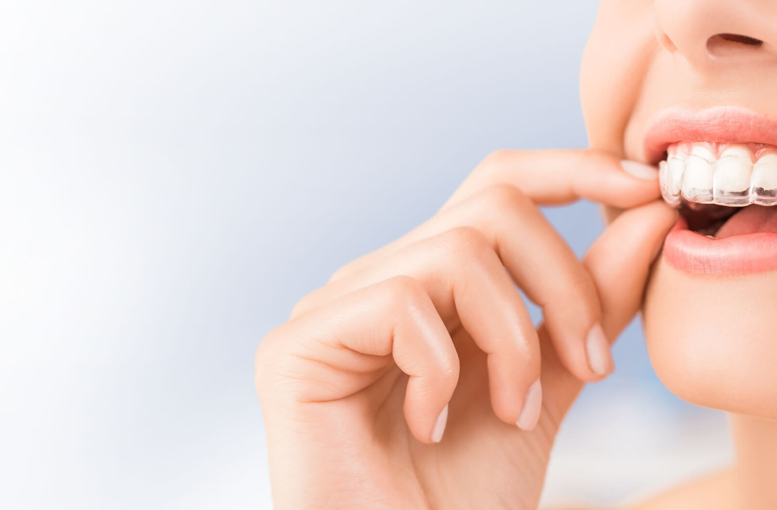 A close-up image of a woman inserting an Invisalign aligner to her top teeth.