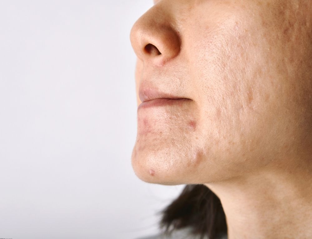 Common Myths About Dark Spots
